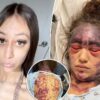 Woman with rare disease claims she’s now blind and bruised after doctors made her get 3 vaccines