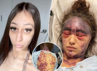 Woman with rare disease claims she’s now blind and bruised after doctors made her get 3 vaccines