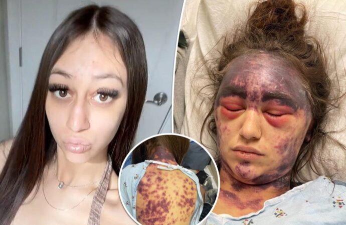 Woman with rare disease claims she’s now blind and bruised after doctors made her get 3 vaccines