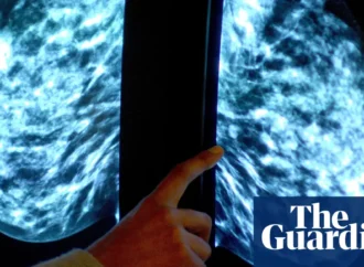 Harnessing Artificial Intelligence: A New Dawn in Breast Cancer Screening