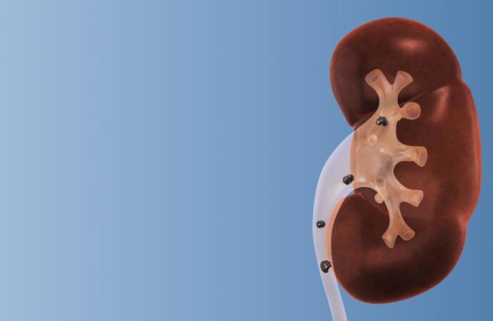 A Growing Trend: The Rise of Kidney Stones in Children