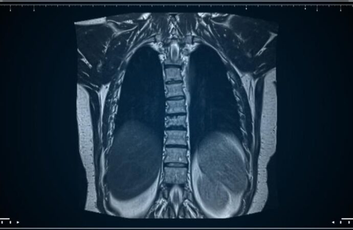 Understanding Long COVID in Children: A New Window into Lung Health