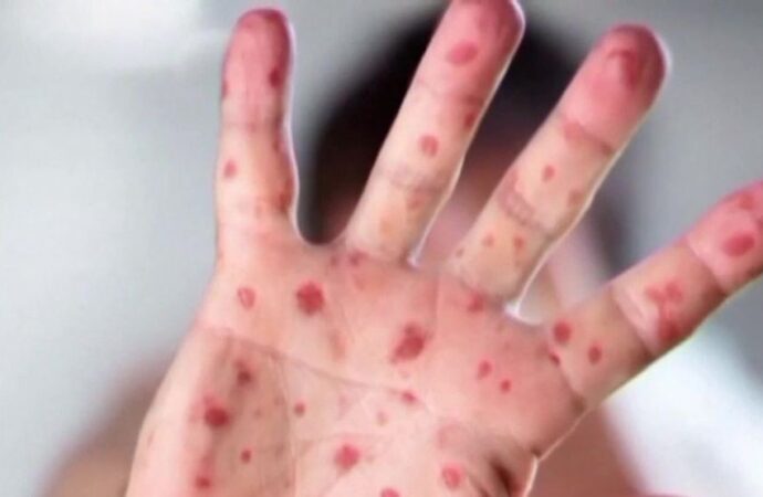 Understanding the Differences: Rubella vs. Measles and the Importance of Vaccination