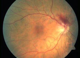 Navigating the Potential Eye Risks of GLP-1 Receptor Agonists: A New Frontier in Diabetes Treatment