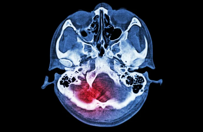 Understanding Stroke Risks: Why Prevention is Key