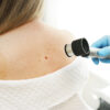 Protecting Your Skin: A Guide to Preventing Melanoma
