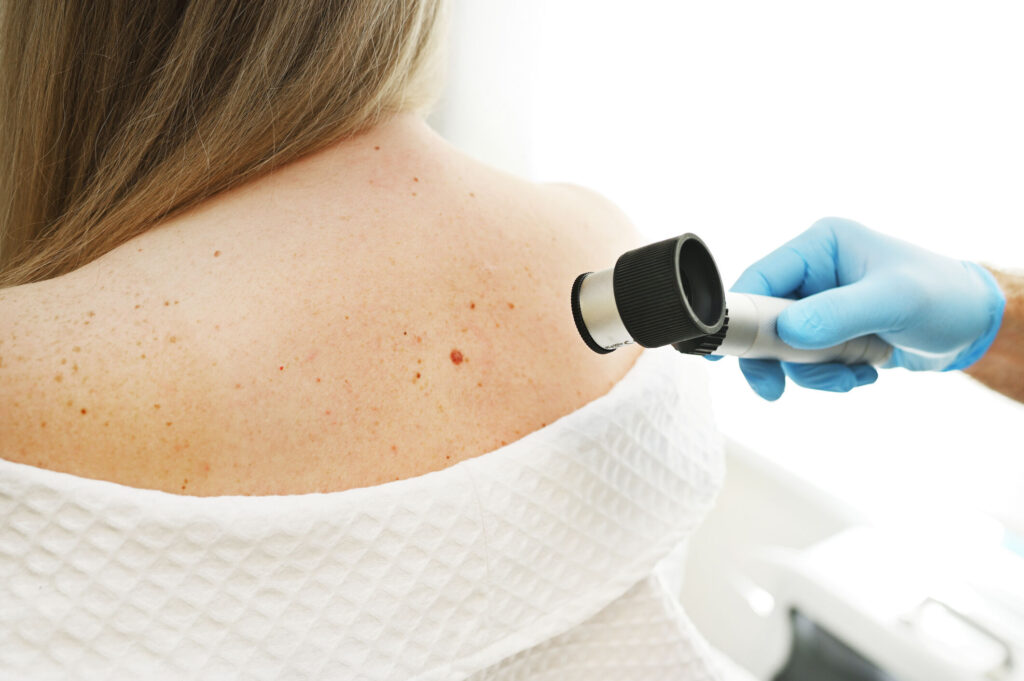 Protecting Your Skin: A Guide to Preventing Melanoma